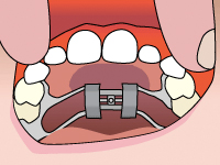 palatal expander